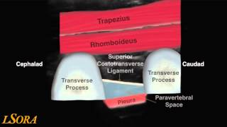 LSORA paravertebral block US guided tutorial [upl. by Grosz]