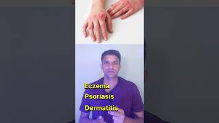 Best skin cream cream for eczema psoriasis dermatitis [upl. by Aimet710]