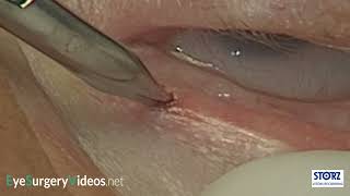 Punctoplasty Punctal 3snip Procedure [upl. by Hollie]