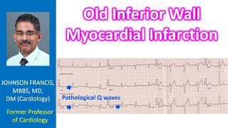 Old inferior wall myocardial infarction [upl. by Norwood73]