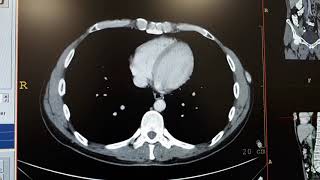 Hemangioma in liver ct [upl. by Zoldi686]