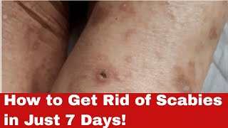 Scabies No More Discover How to Get Rid of Scabies FAST [upl. by Aiciles849]