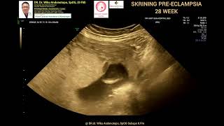 Skrining PreEclampsia 28 weeks [upl. by Aniez264]