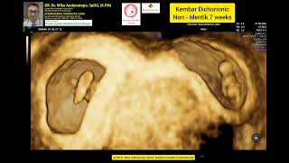 7 Weeks Dichorionic Twins [upl. by Clark485]