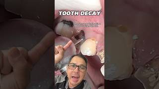 Removing a HUGE amp DEEP Buccal Cavity on a Premolar  In Office to Hands On Dental Training shorts [upl. by Detta]