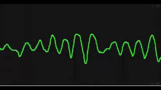 Ventricular Tachycardia Torsades De Pointes [upl. by Rotce]