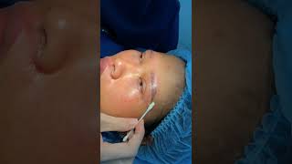 wenkbroue lig laer ooglid chirurgie krimp die philtrum xuhuongyoutube lamdep thongthainguyen [upl. by Ardnuhsor67]