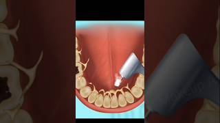 asmr tooth cavities  caries removal treatment [upl. by Niala]