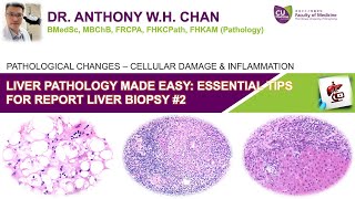 Liver Pathology Made Easy 27  Essential Tips for Reporting Medical Liver Biopsy [upl. by Anilev561]