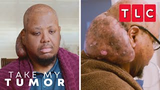 Arlins Massive Neck Tumor Embarrasses Him  Take My Tumor  TLC [upl. by Almallah286]