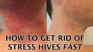 Stress Hives Treatment  How To Get Rid Of A Stress Rash FAST [upl. by Josefa154]