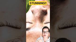 ULTIMATE PORE STRIP REMOVAL  How To Prep Skin For Pore Strips shorts [upl. by Murrah531]