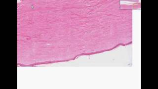 Histopathology Skin kidney Systemic sclerosis scleroderm [upl. by Lotta]