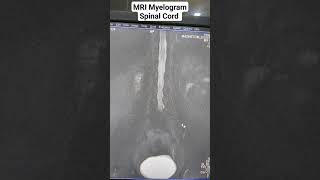 Uncover the Beginners Guide to MRI Spine Myelogram Sequences [upl. by Editha968]