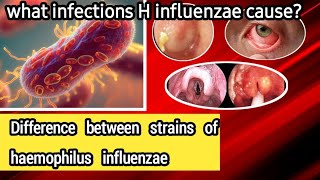 Haemophilus influenzae  Microbiology  What is the difference between strains bacteria [upl. by Shanna]