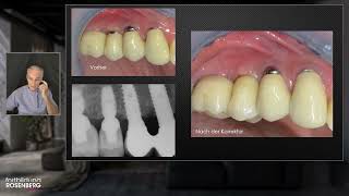 Trailer «Reduzierte PeriImplantitis» – Prof Dr Mauro Marincola [upl. by Anaiad]