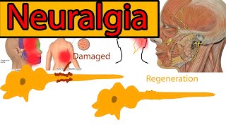 Neuralgia Explained under 3 minutes Trigeminal Neuralgia symptoms and treatment [upl. by Ty459]