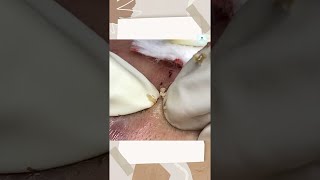 Big Cystic Acne Blackheads Extraction Blackheads amp Milia Whiteheads Removal Pimple Popping shorts [upl. by Nylarak]