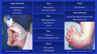 Trisomy 18 Edward Syndrome Dysmorphic Features [upl. by Lek]