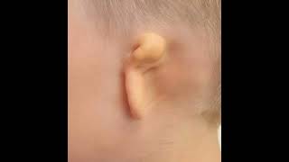 Microtia Awareness Day 👂🦻microtiaawarenessday speechandhearing hearingaids speechtherapy [upl. by Ytsenoh]