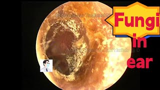 Ear wax removingEar fungal dry pieces cleaning processing12mins20221117 [upl. by Gershon]