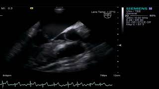 TEE  Mitral Valve involvement of APLS [upl. by Josh]