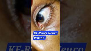 KF ring in eye examination kayser fleischer ring  wilson disease pediatrics neurology wilson [upl. by Beghtol]