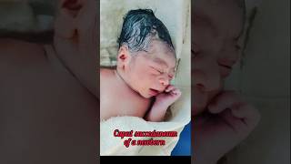 caput succedaneum of a newbornnewbornbaby babyshorts [upl. by Shae704]