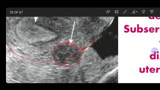 Ultrasound of Fibroids  Sonographic Appearance of Fibroids  Fibroids Differential Diagnosis [upl. by Nosyd335]