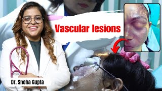 Alma IPL Laser is Best for Vascular Lesions संवहनी घावों के लिए उपचार क्या है [upl. by Leksehc]