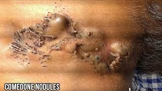 Nevus Comedonicus  Dermatology Discussion [upl. by Ekud224]