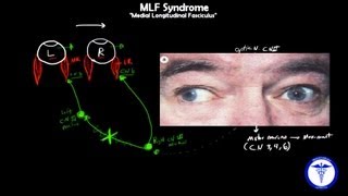 MLF syndrome  Internuclear Ophthalmoplegia MADE EASY [upl. by Dreher545]