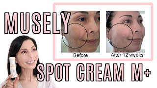 My Musely Spot Cream M Update With Before amp After Pictures of My Melasma [upl. by Ahterahs660]