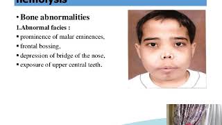 A case of thalassemia  pediatrics  5th grade  Dr Naglaa Samy Osman [upl. by Heidt]