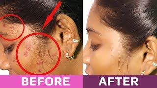 Tips to Remove Pimples Overnight  Beauty Tips in Tamil [upl. by Godewyn]