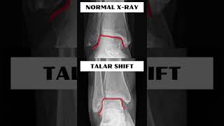 What is TALAR SHIFT [upl. by Farly]