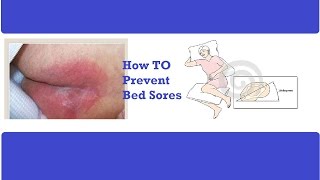 How to Prevent Bed Sores Pressure Ulcer Prevention  How to Prevent Bed Sores for a Sick Patient [upl. by Goldin]