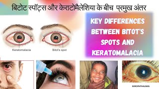 बिटोट स्पॉट्स और केराटोमैलेशिया के बीच अंतरdifferences between Bitots Spots and Keratomalacia [upl. by Aysa]