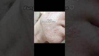 Simple Fungal acne routine fungalacne fungalacneroutine skincare shorts videosIneed [upl. by Schluter]