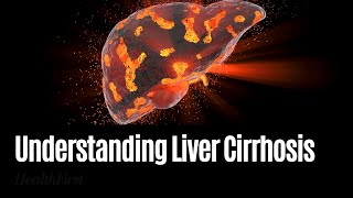 liver cirrhosis etiology pathogenesis clinical features and treatment liver pathology symptoms [upl. by Yenettirb]