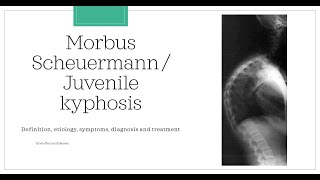 Morbus Scheuermann  Juvenile kyphosis Essential medicine [upl. by Taylor478]