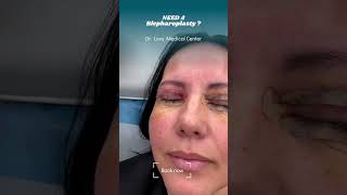 Blepharoplasty surgery eyelid  Doctor Levy Romania plastic surgeon [upl. by Isa553]