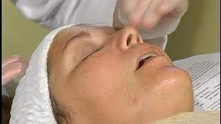 Hypopigmentation Skin Treatments [upl. by Sukram683]