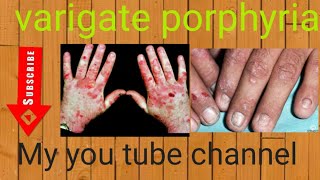 skin disease  varigate porphyria [upl. by Wakefield]