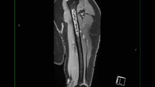 Conventional Chondrosarcoma Humerus [upl. by Etteval751]