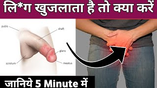 Balanitis treatment in Hindi  lig जब खुजलाता है तो क्या करें [upl. by Hgieliak]