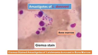 Giemsa Stained Amastigotes of Leishmania donovani in Bone Marrow [upl. by Bonucci]