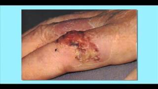 Squamous Cell Carcinoma Skin Cancer [upl. by Viens]