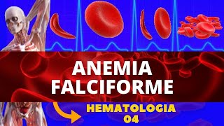 ANEMIA FALCIFORME ANEMIA HEREDITÁRIA  HEMATOLOGIA [upl. by Goldfarb835]