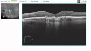 OCT Tutorial Geographic Atrophy in Dry AMD [upl. by Elleirol536]